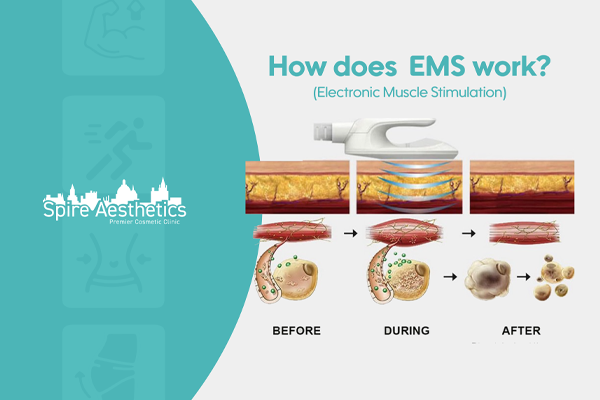EMS treatment for post pregnancy weight loss treatment Canvey Island