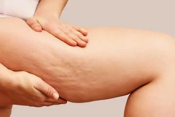Image of woman showing leg with cellulite Canvey Island