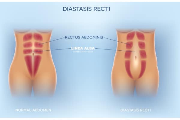 What Non-Surgical Options Are Available for Diastasis Recti Canvey Island?