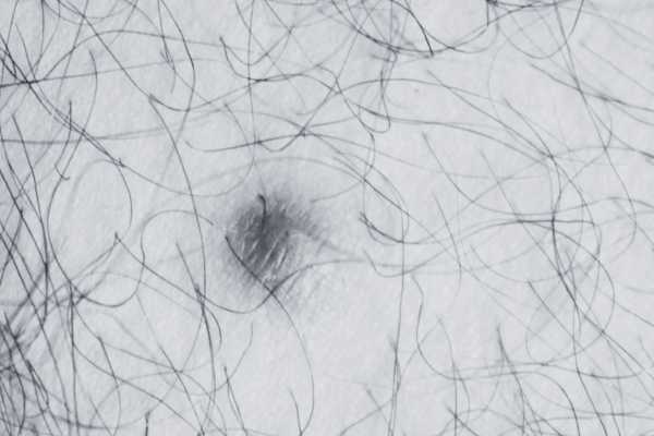 Dermatofibroma removal Canvey Island made simple! Book in today!