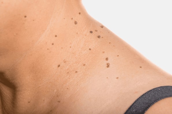Are you looking for easy skin tag removal Canvey Island - then contact Spire today!