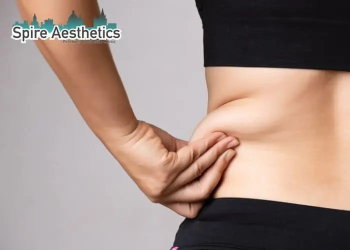 Image of woman pinching fat on their hips Canvey Island. Fat Freezing treatment