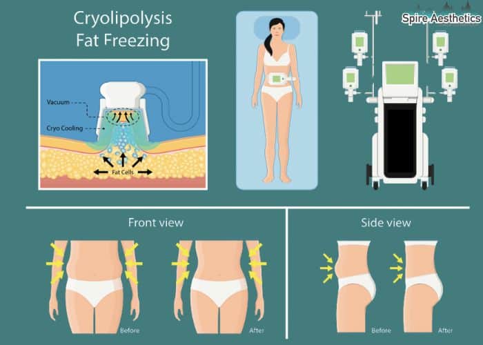 Image of diet and fat freezing combined for best results for Spire Aesthetics Canvey Island