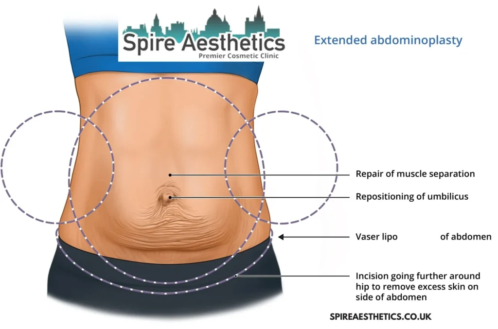 Understanding Loose Skin After Gastric Band Canvey Island Surgery and HIFU Treatment