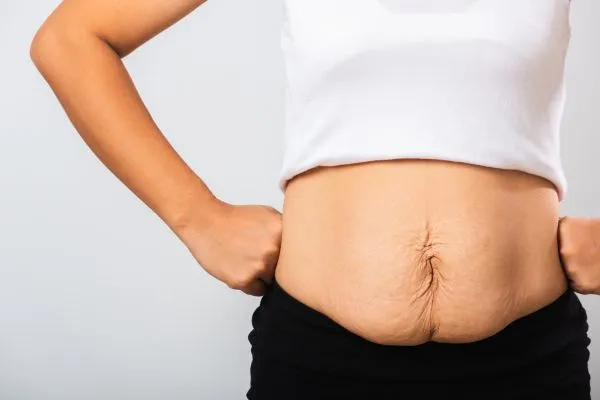 Image of a woman's stomach after weight loss with sagging skin following a gastric band Canvey Island