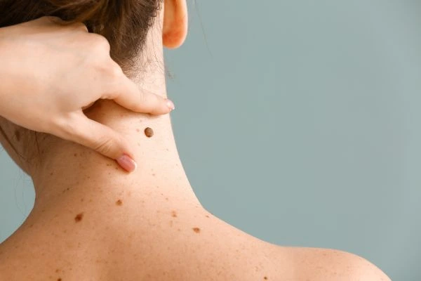 Prices and promotions for blemish removal Canvey Island contact our team today!