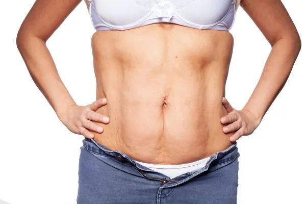 sagging skin on woman's stomach after weight loss injections Canvey Island