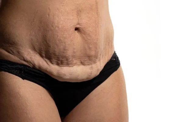 Image of womans stomach after weight loss injections Canvey Island showing saggy skin