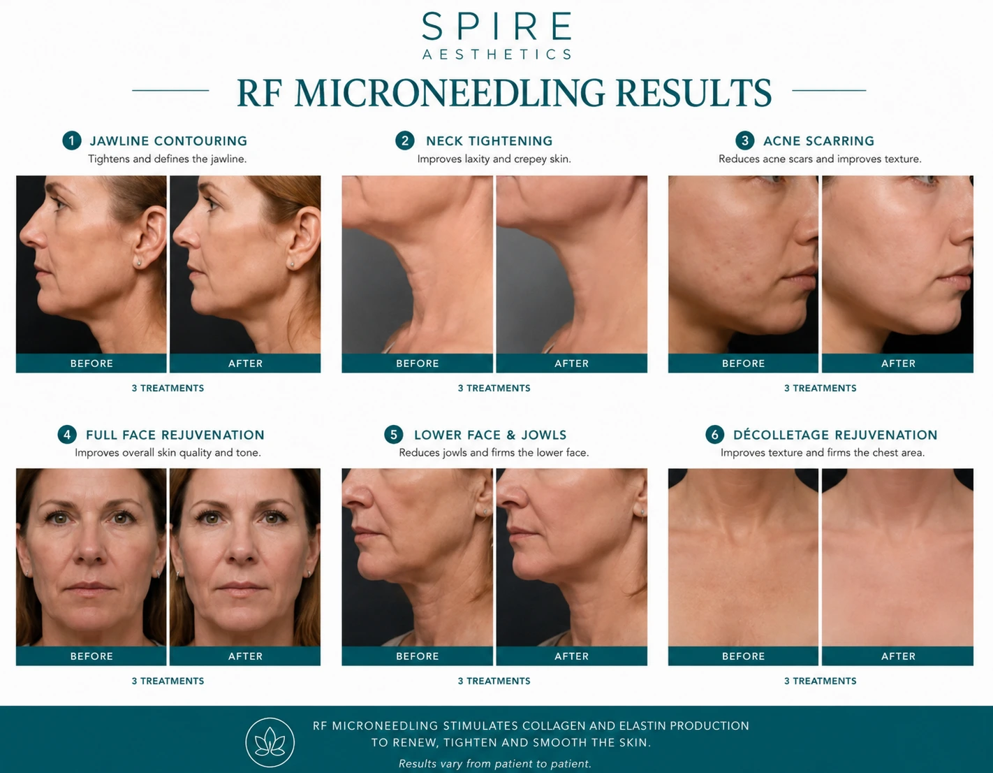 RF Microneedling Skin tightening Canvey Island results