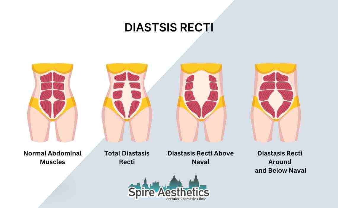 Is Non-Surgical Diastasis Recti Treatment Right for You? Common Concerns Answered Canvey Island